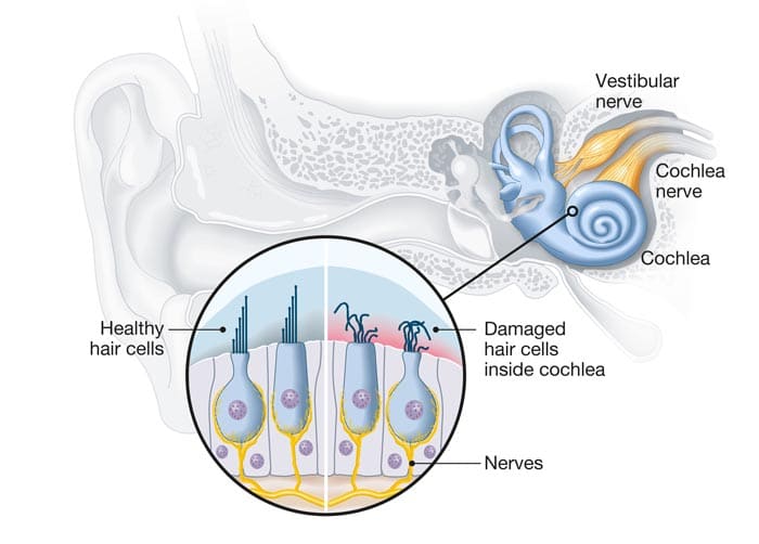 Medical diagram showing damage hair cells inside the cochlea